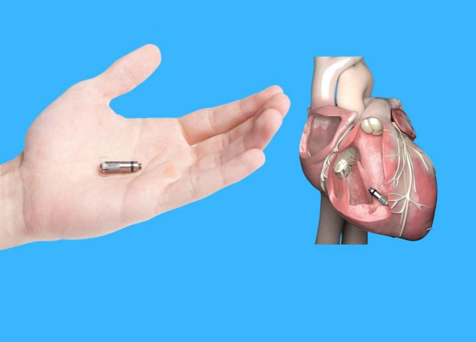 New Medtronic Pacemaker