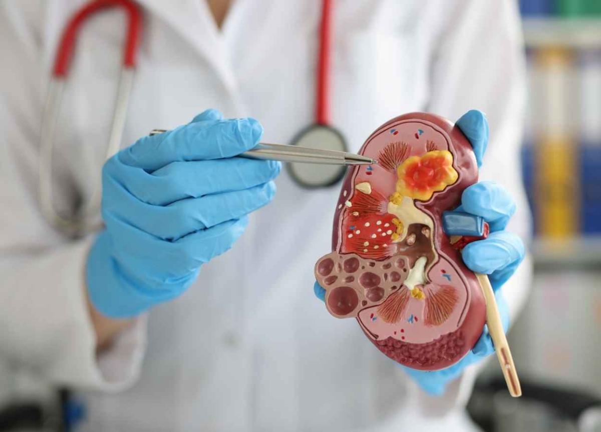 Dapagliflozin cost effective treatment for CKD PharmaTutor