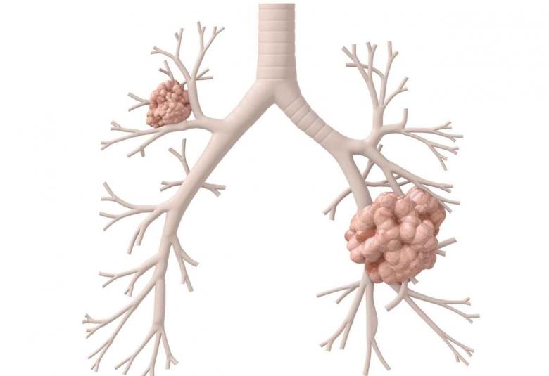 Roche Tecentriq helps certain people with early lung cancer live