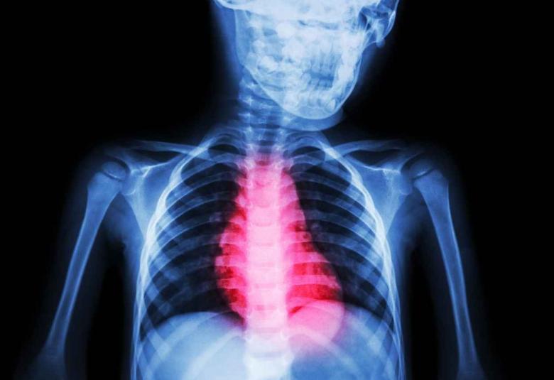 Is it possible to personalise sudden cardiac death prevention after myocardial infarction