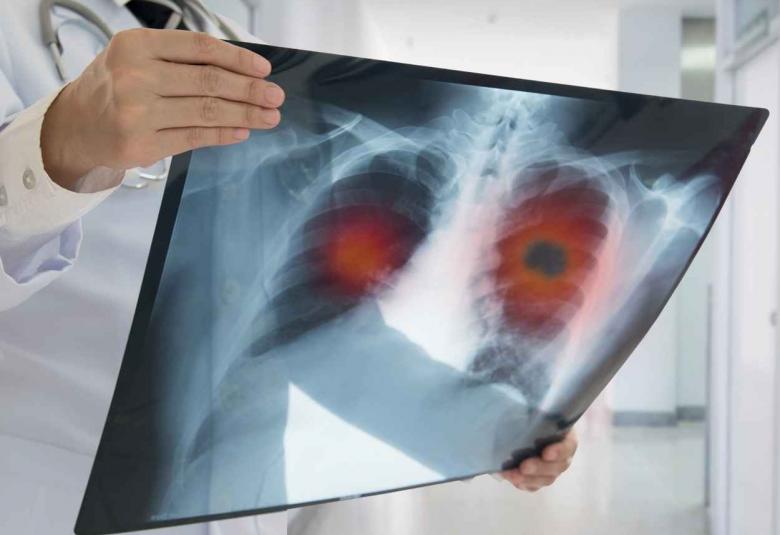 CANOPY-1 Phase III study did not demonstrate the statistically significant primary endpoints