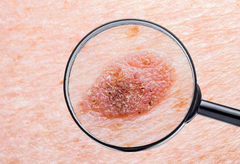 BioNTech Receives FDA Fast Track Designation for its FixVac Candidate BNT111 in Advanced Melanoma
