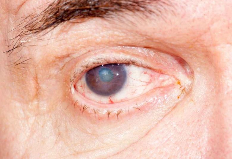 OKYO Pharma Limited announces First-in-Class Drug Candidate OK-101 Displaying Both Anti-inflammatory and Ocular Pain-Reducing Potential to Treat Dry Eye Disease