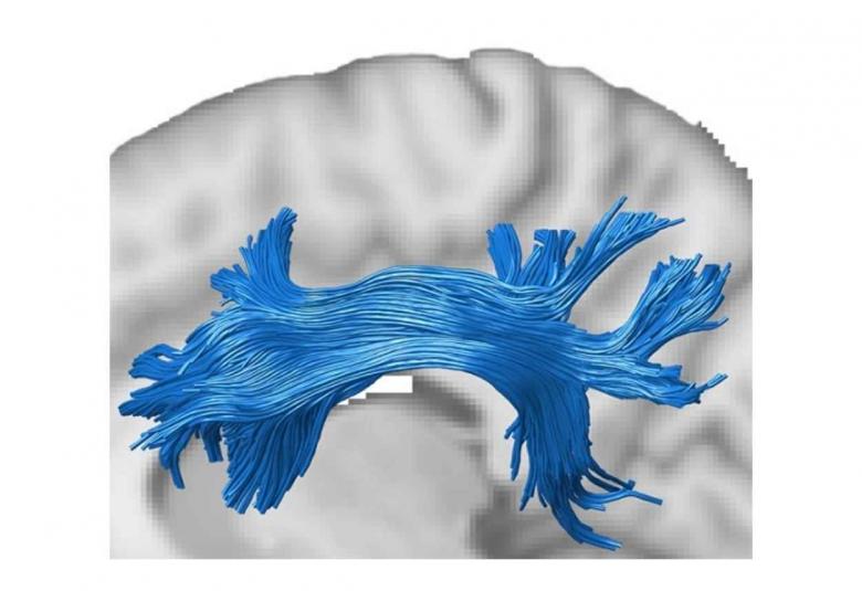 Study could help better management of Alzheimer’s patients 