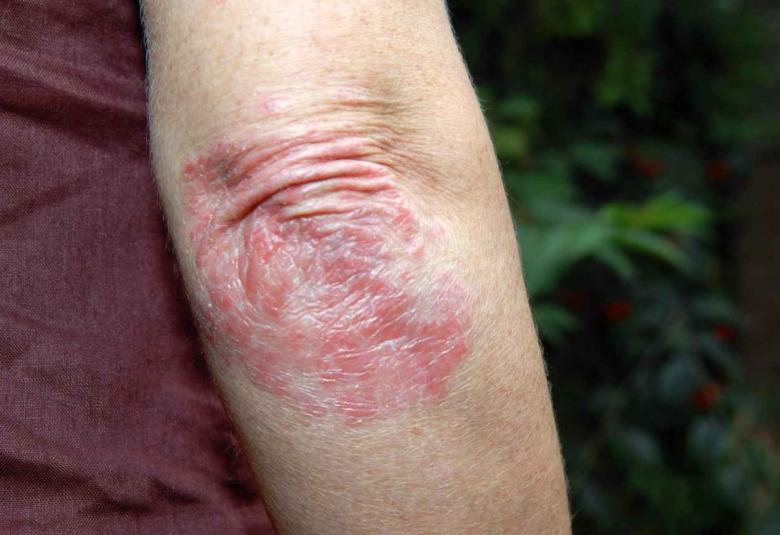Psoriasis drug of Boehringer Ingelheim gets FDA nod