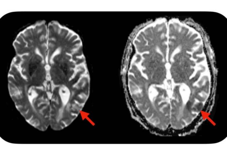 Simple blood test predicts neurotoxic complications of CAR-T cell therapy