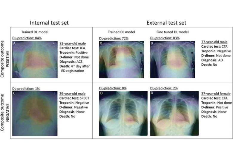 Researchers Use AI to Triage Patients with Chest Pain