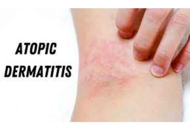 Intas launches treatment of mild to moderate Atopic Dermatitis