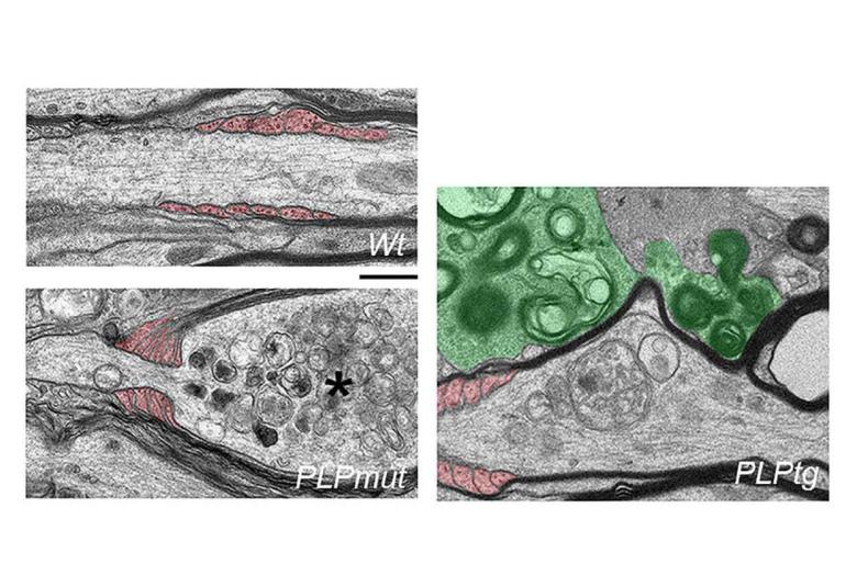 Neurodegeneration in Myelin Disease : No Myelin is Better than Bad Myelin