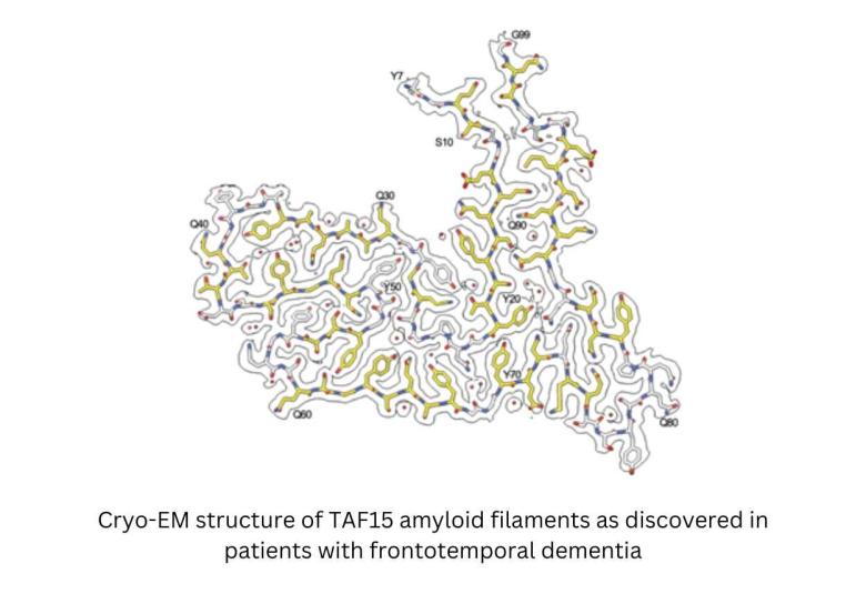 Protein found in brain linked to frontotemporal dementia