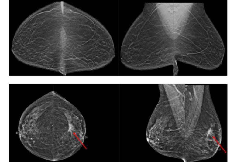 AI-assisted breast-cancer screening may reduce unnecessary testing