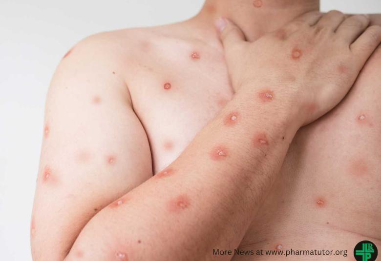 WHO Director-General declares mpox outbreak a public health emergency of international concern