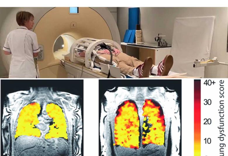 New scan method unveils lung function secrets