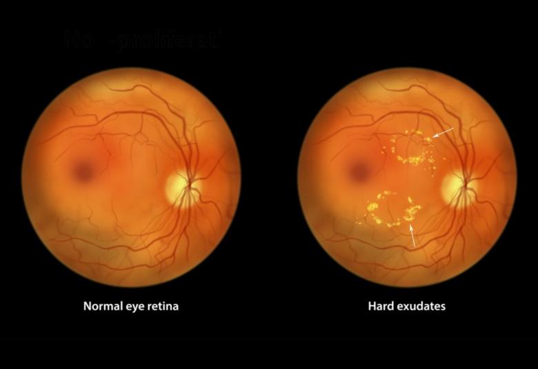 Managing your diabetes can help prevent associated vision loss