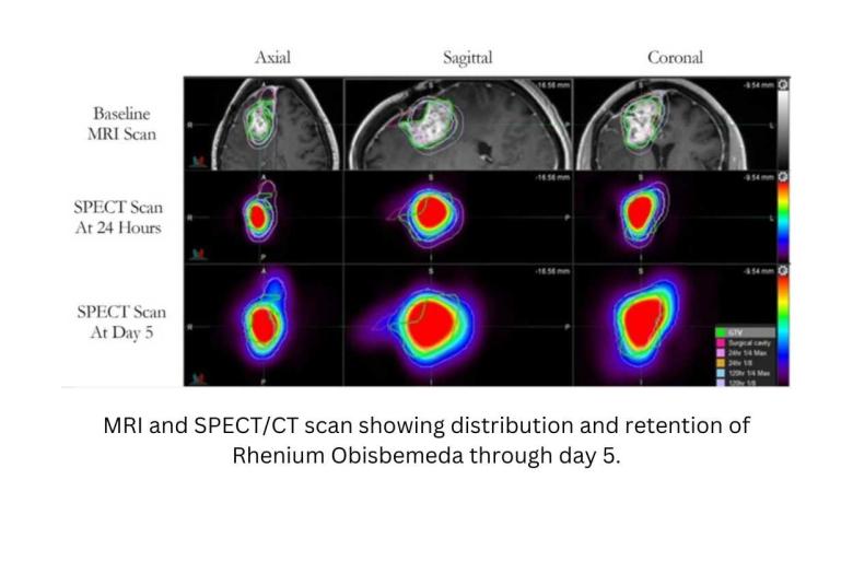 UT Health San Antonio develops drug found to more than double survival time for glioblastoma patients