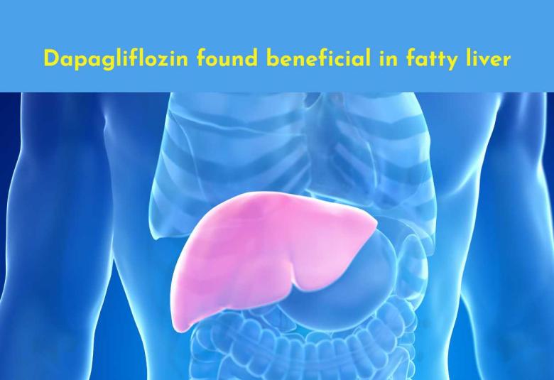 Dapagliflozin found beneficial in fatty liver