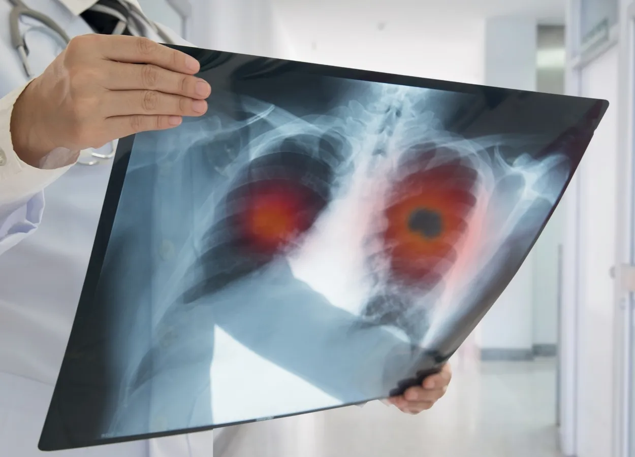 Lung Cancer medicine Mobocertinib got positive result for early trial