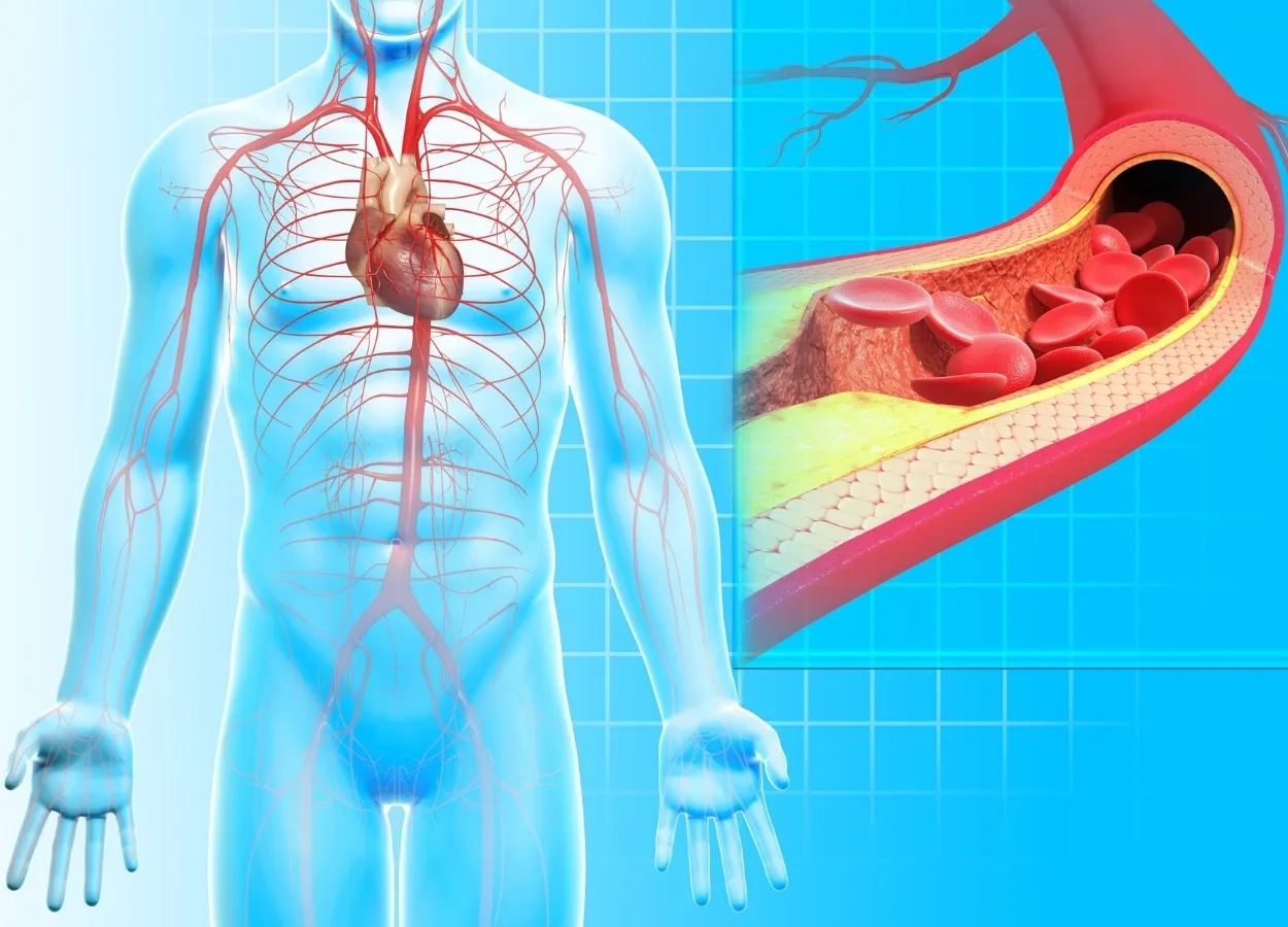 Atherosclerosis can accelerate the development of clonal hematopoiesis
