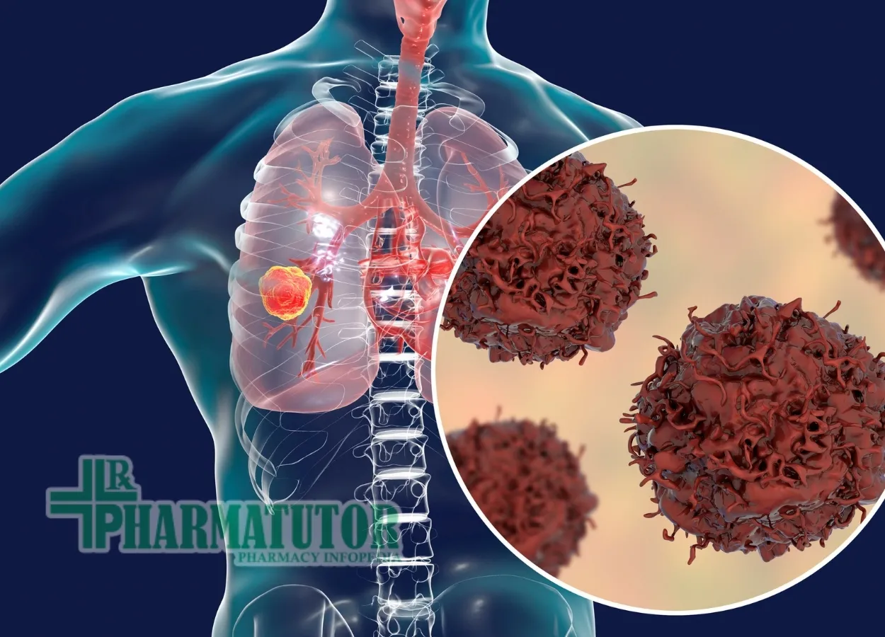 Enzymatic danse macabre of lung cancer