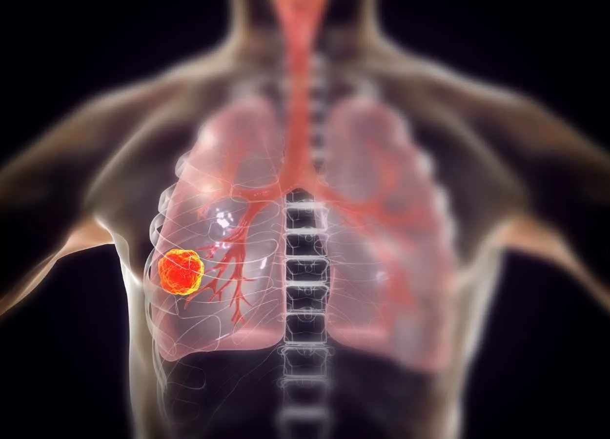 Merck advances ATR inhibitor Berzosertib in small cell lung cancer
