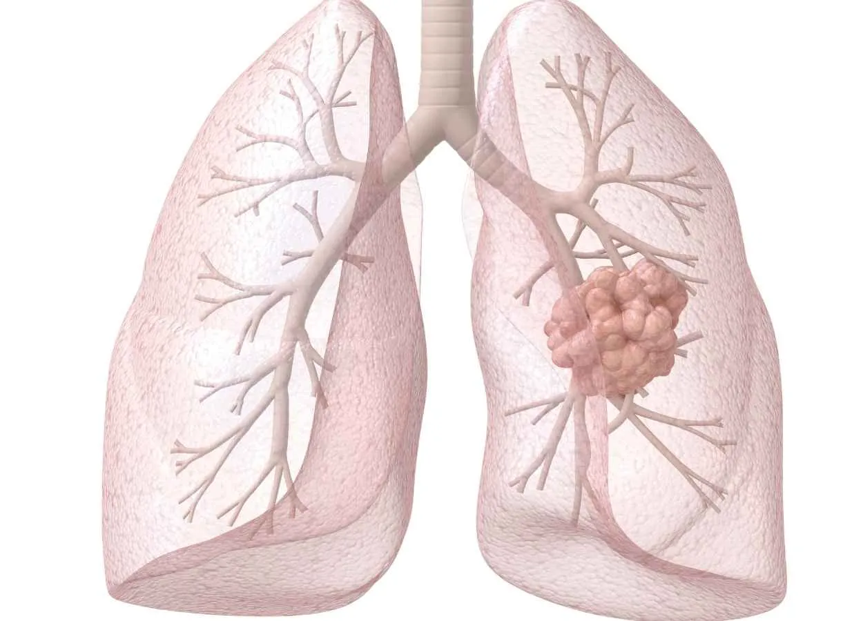 Scientists identify protein that could serve as a therapeutic target in lung cancer