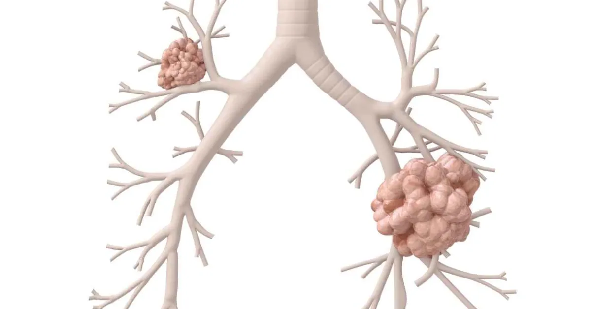 Roche Tecentriq helps certain people with early lung cancer live