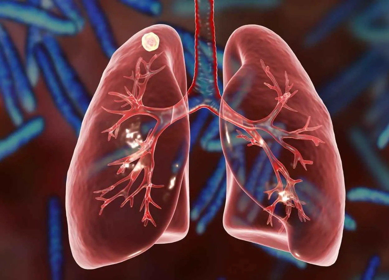 Tulane researchers develop test that detects childhood TB a year ahead of current screenings