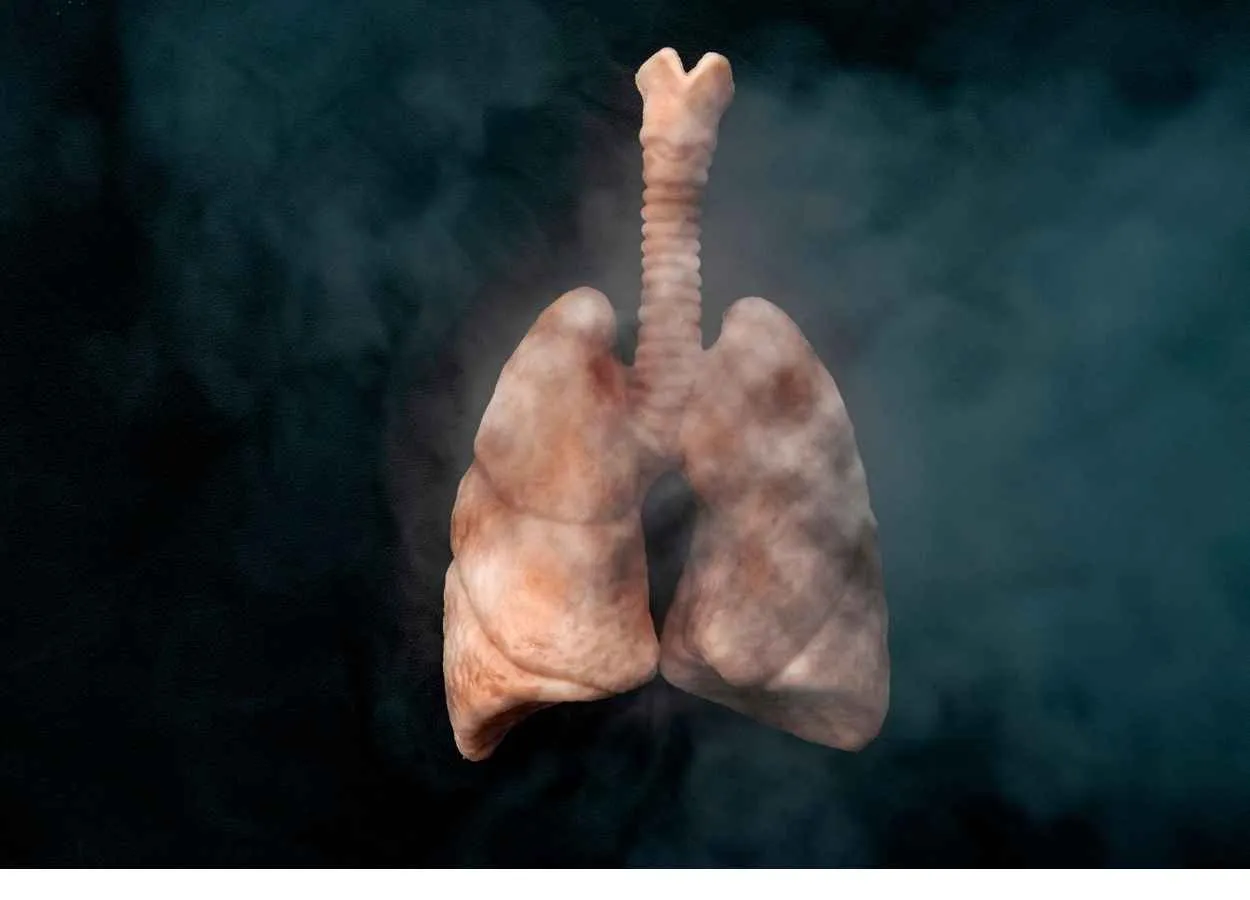 Sandoz to launch ready-to-dilute generic Pemetrexed to treat most prevalent form of lung cancer in Europe