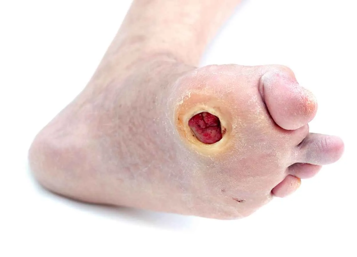 Positive clinical outcomes for PriMatrix Dermal Repair Scaffold for the management of diabetic foot ulcers