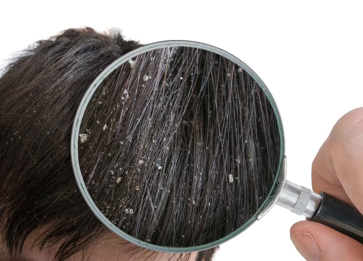 Piroctone Olamine Effective Active for Dandruff