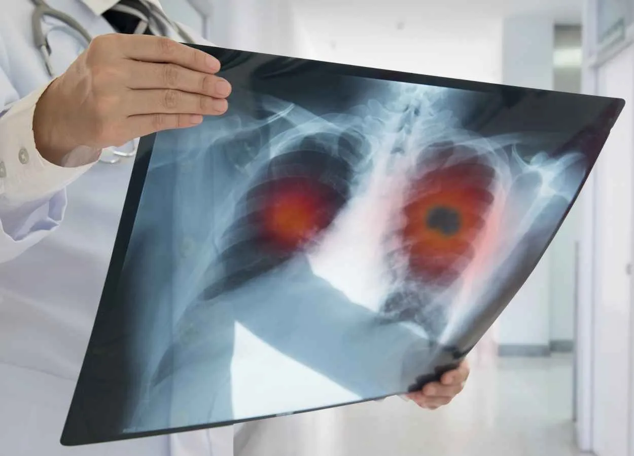 CANOPY-1 Phase III study did not demonstrate the statistically significant primary endpoints