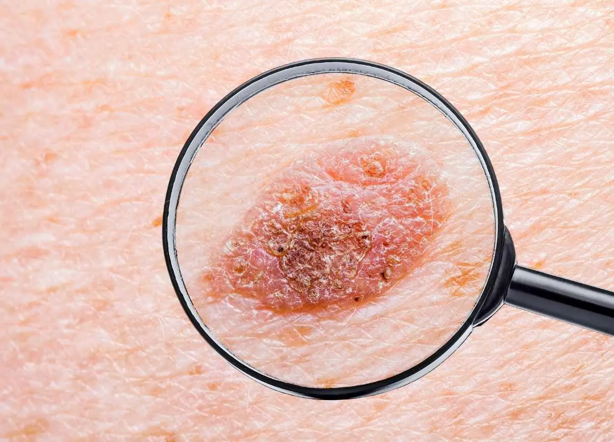 BioNTech Receives FDA Fast Track Designation for its FixVac Candidate BNT111 in Advanced Melanoma