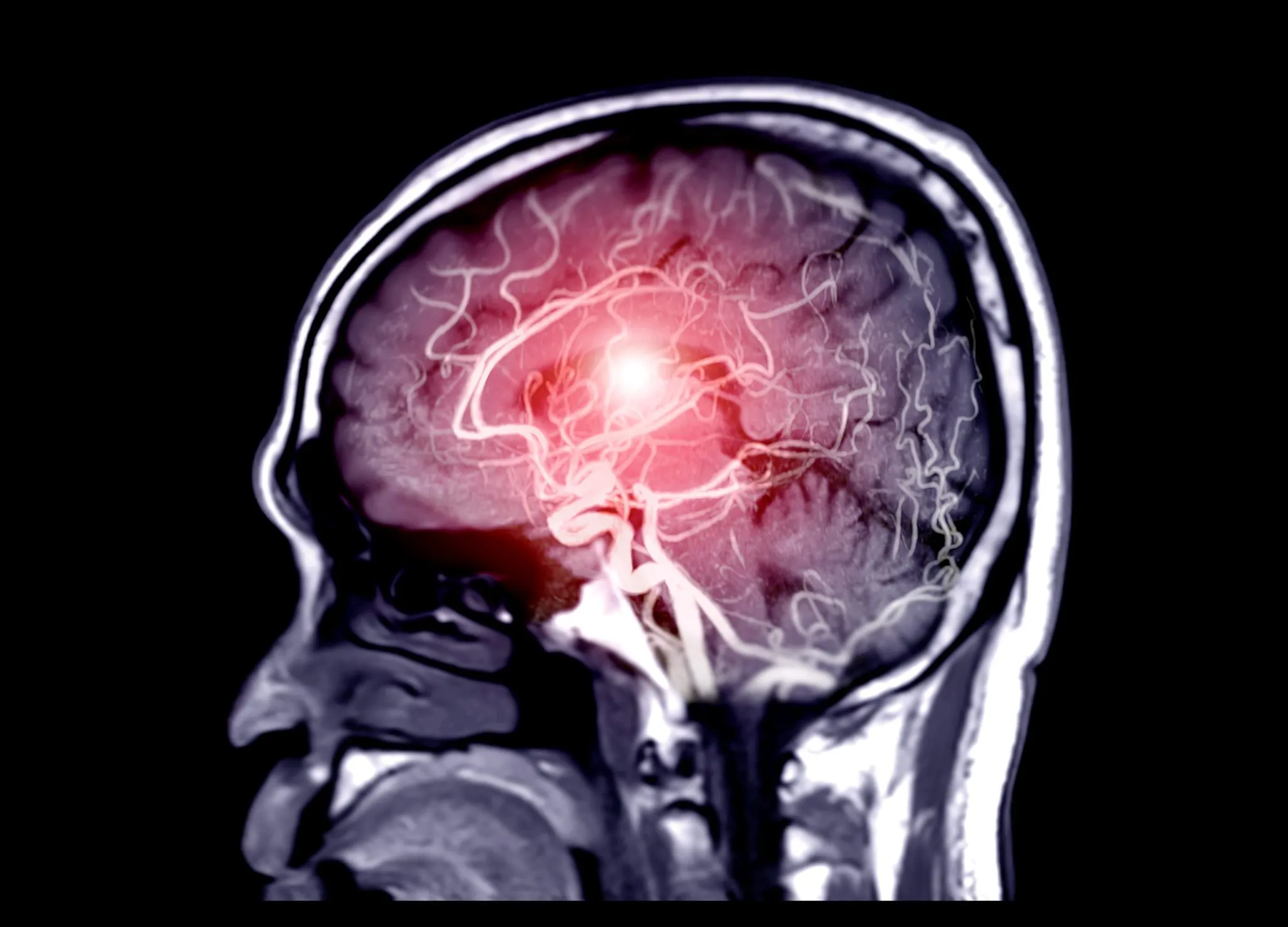 Researchers Reveal Surprising Findings on How Salt Affects Blood Flow in the Brain