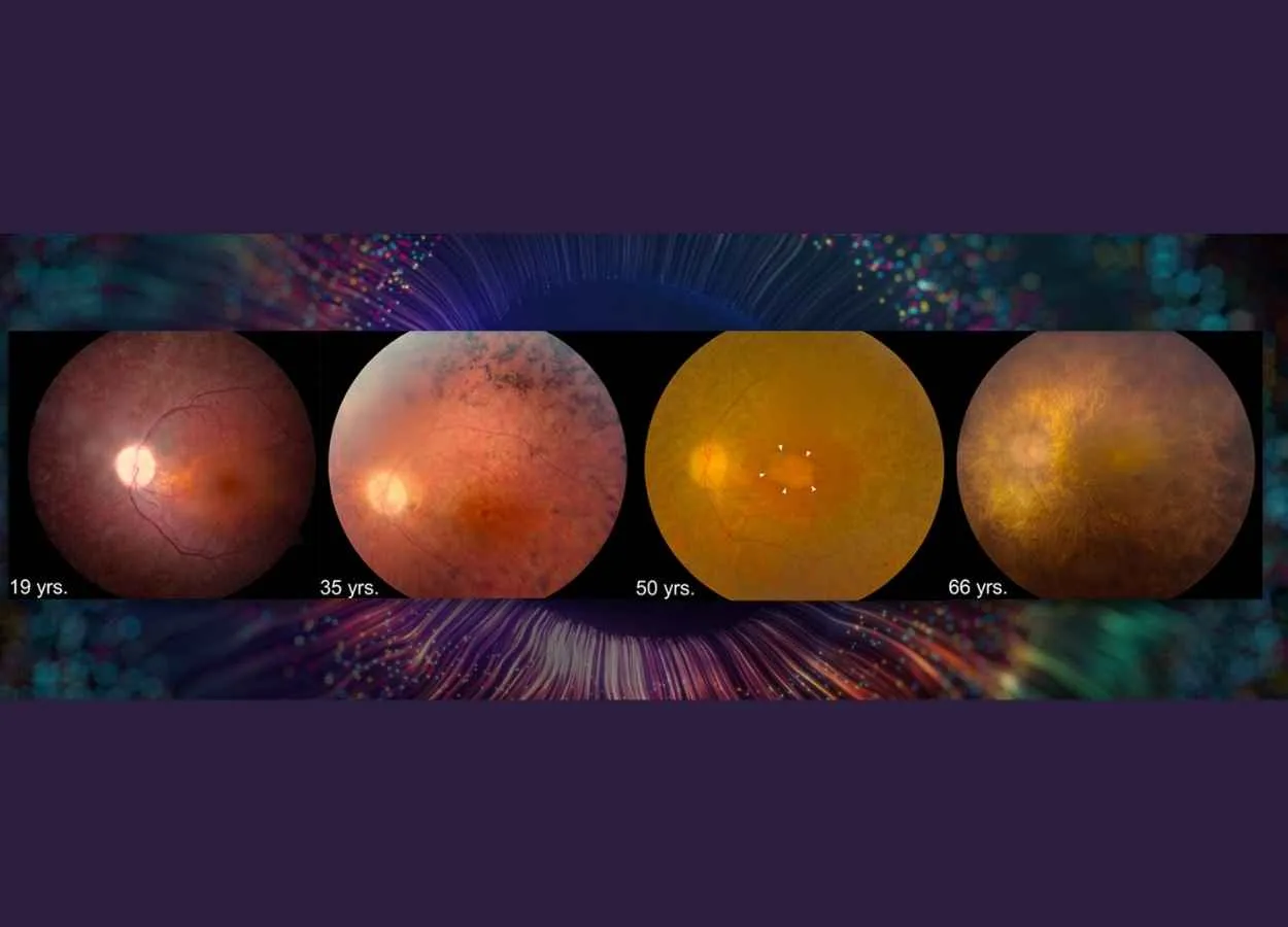 Retinoid Therapy May Improve Vision in People with Rare Genetic Disorder