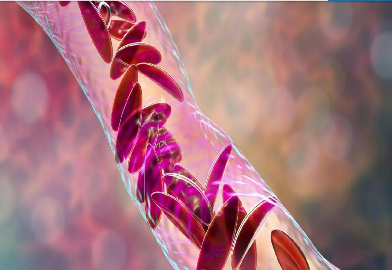 Experimental Gene Therapy Reverses Sickle Cell Disease for Years