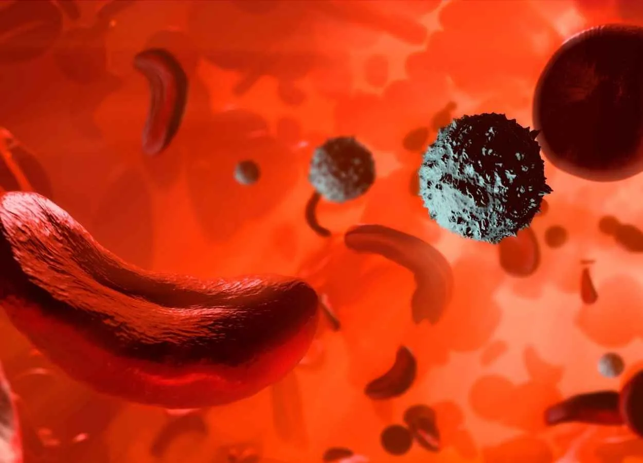 Hyrdroxyurea approved by DCGI for Sickle cell anemia
