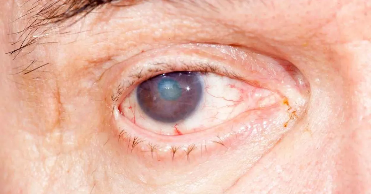 OKYO Pharma Limited announces First-in-Class Drug Candidate OK-101 Displaying Both Anti-inflammatory and Ocular Pain-Reducing Potential to Treat Dry Eye Disease