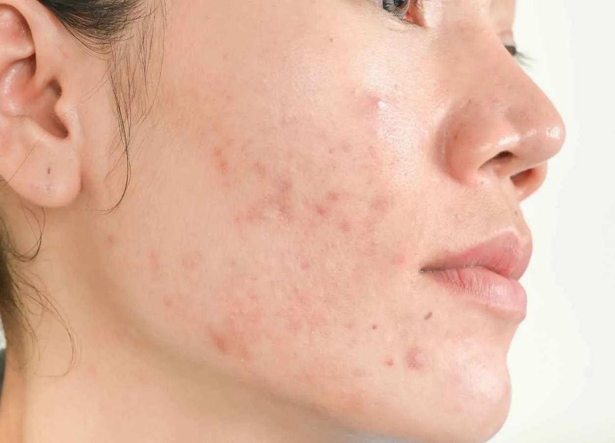 Sanofi to acquire Origimm Biotechnology in first move to treat acne with vaccine-based immunotherapy