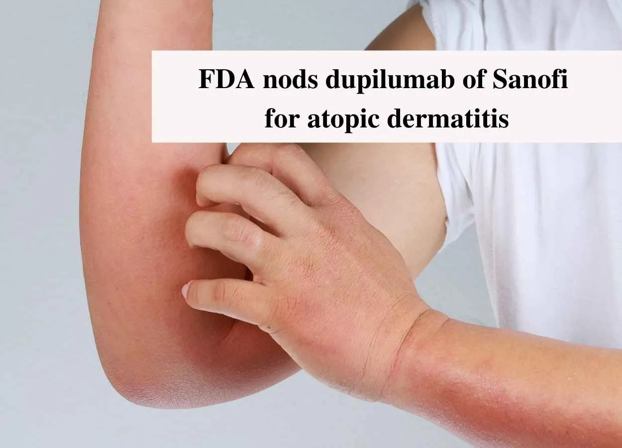 FDA nods dupilumab of Sanofi for atopic dermatitis