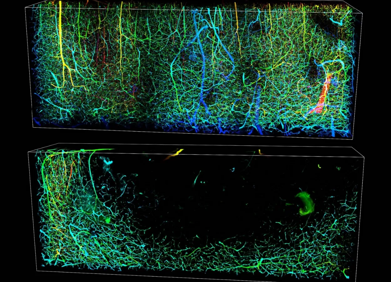 The drug gabapentin may boost functional recovery after a stroke