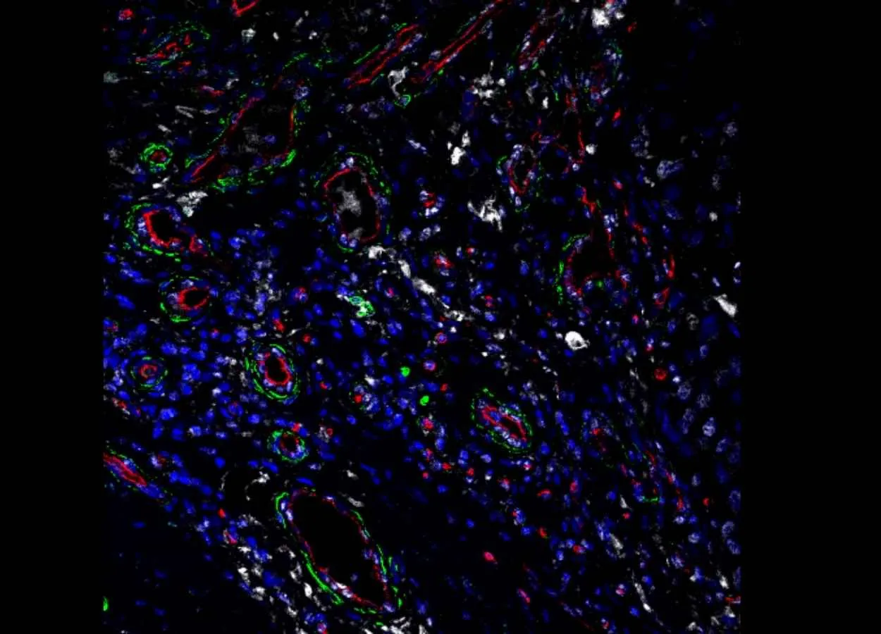 Stress Protein in Fibroblasts May Be a Good Target for Future Cancer Drugs