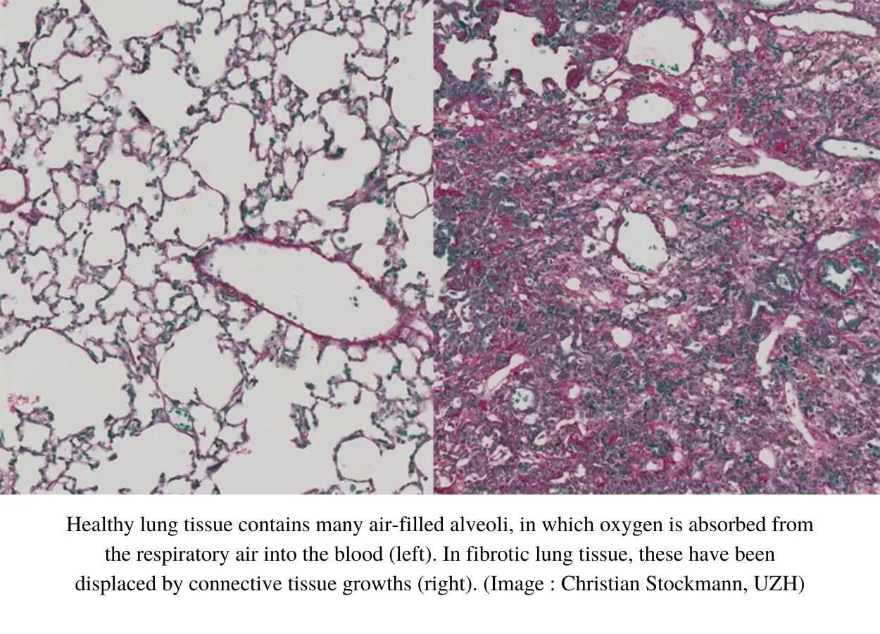 Immunotherapy Reduces Lung and Liver Fibrosis in Mice