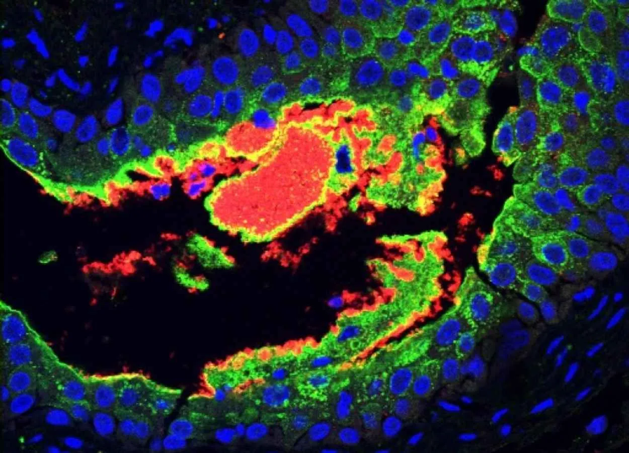 New study explains link between diabetes and UTIs