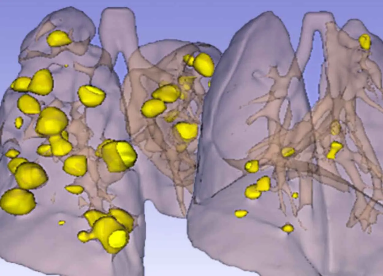 Outdated cancer drug in combination found effective against lung cancer