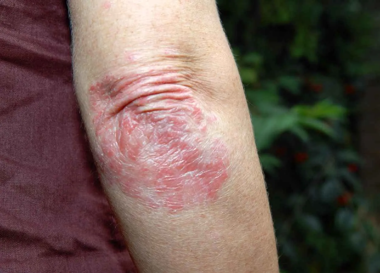 Psoriasis drug of Boehringer Ingelheim gets FDA nod