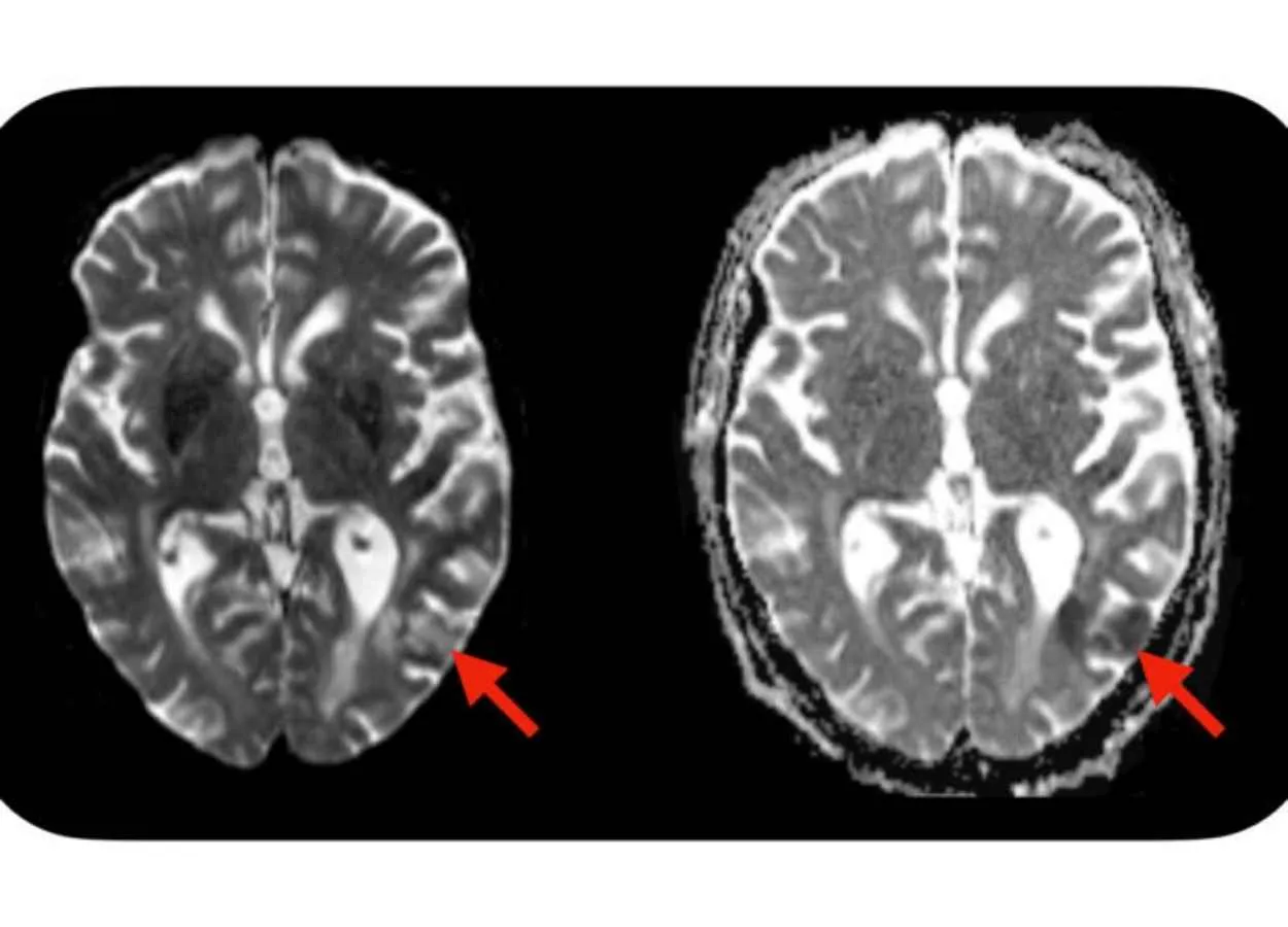 Simple blood test predicts neurotoxic complications of CAR-T cell therapy