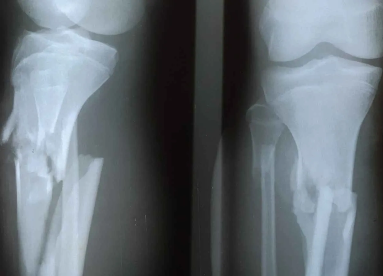 Antisepsis Agents Interchangeable in Reducing Infection Risk in Open Fracture Surgeries