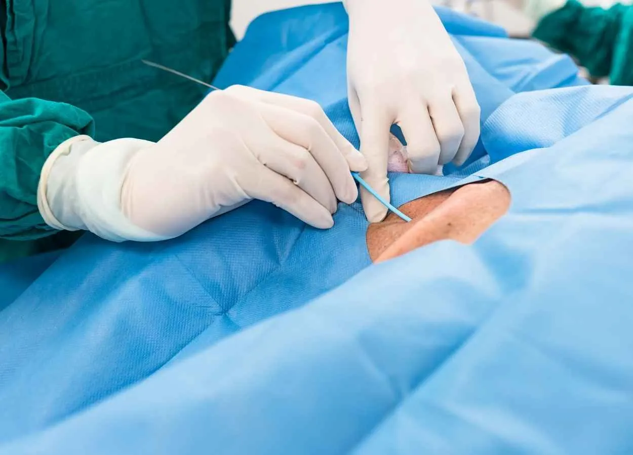 Seizures more common after venous stroke