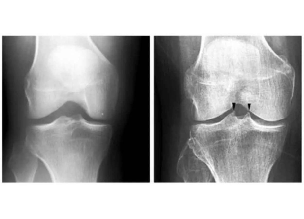 Early sign of osteoarthritis by AI will improve outcome