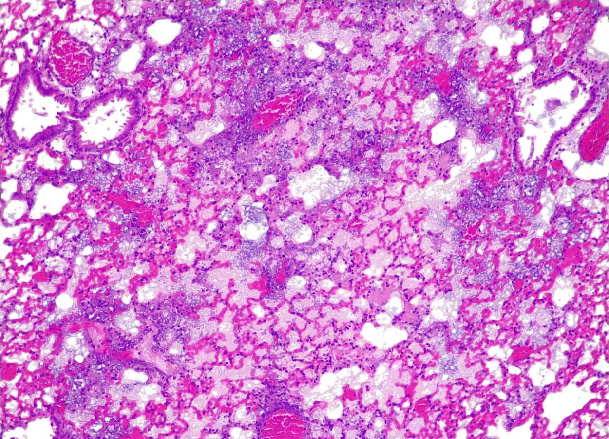 First living medicine created to treat drug resistant lung infections